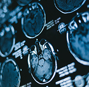 听神经瘤手术后容易复发吗？