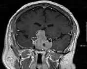 垂体瘤需要手术吗？垂体瘤的手术指征详细介绍