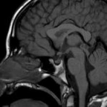 基底节区生殖细胞瘤早期症状有哪些？