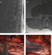 脊髓神经鞘瘤手术、放疗、综合治疗，哪一种预后更好？