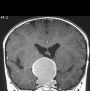 颅咽管瘤二次手术风险