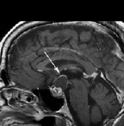 颅咽管瘤治疗较新进展