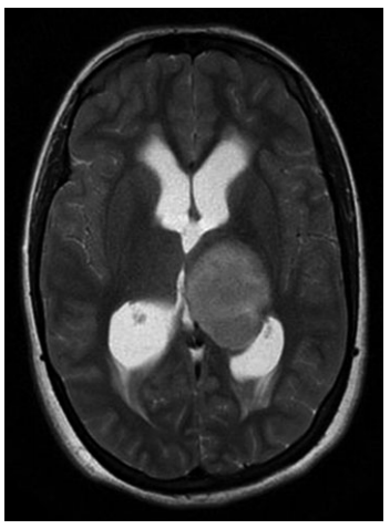 丘脑胶质瘤的影像学研究与分类