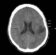 原发性胶质瘤是恶性还是良性？