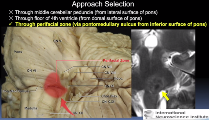 <a href='/qianyan/xueguanliu/' target='_blank'><u>脑干海绵状血管瘤</u></a>