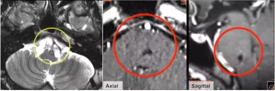 脑干海绵状血管瘤案例