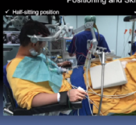 脑干海绵状血管瘤半坐位手术全切，重度残疾恢复至正常生活