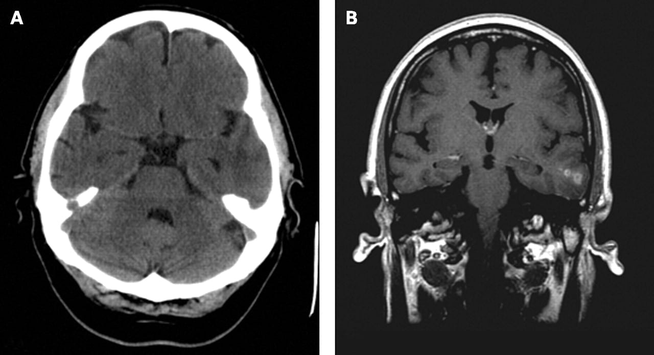 胶质母细胞瘤预后