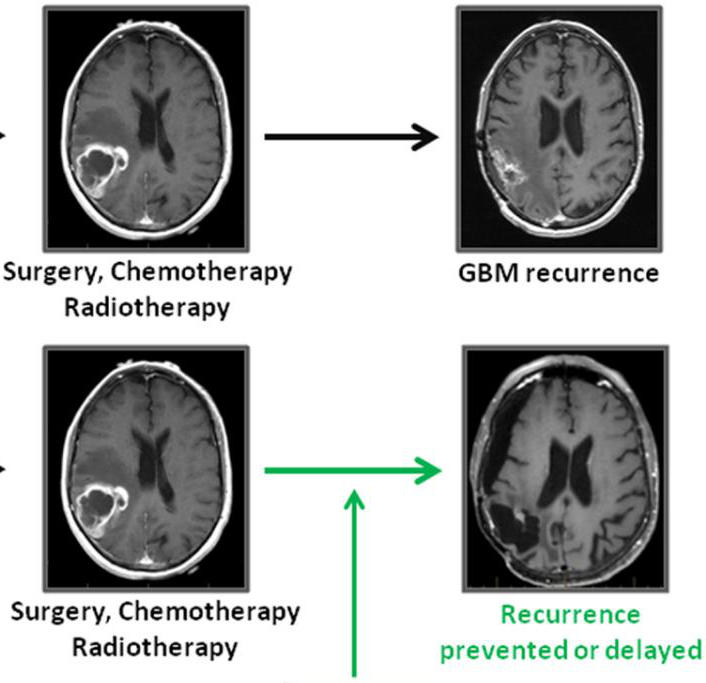 胶质母细胞瘤治疗方法