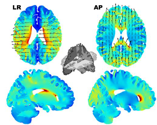 胶质母细胞瘤 <a href='/qianyan/litt/' target='_blank'><u>LITT</u></a>