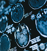 下丘脑错构瘤几岁能做手术？