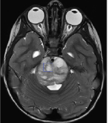 脑桥胶质瘤放疗多少次能看出效果？