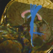 延髓胶质瘤是绝症吗能治好吗？