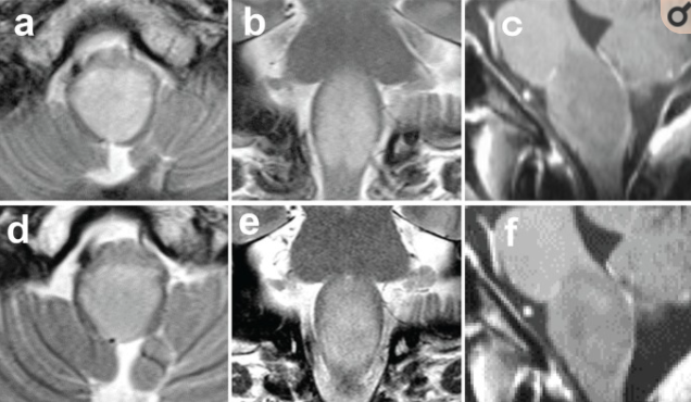 脑干延髓胶质瘤