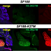脑桥胶质瘤没法手术可以做基因检测吗?