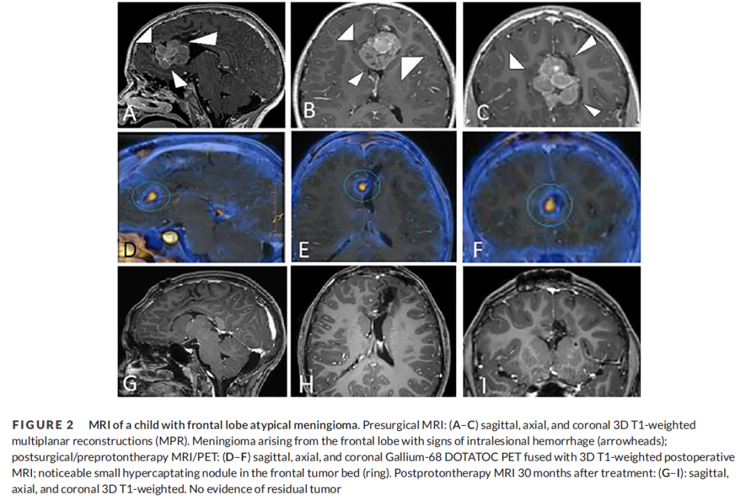 非典型脑膜瘤（WHO II级）手术辅助质子治疗，预后良好