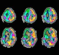 小儿癫痫发作前有什么征兆？怎么控制？