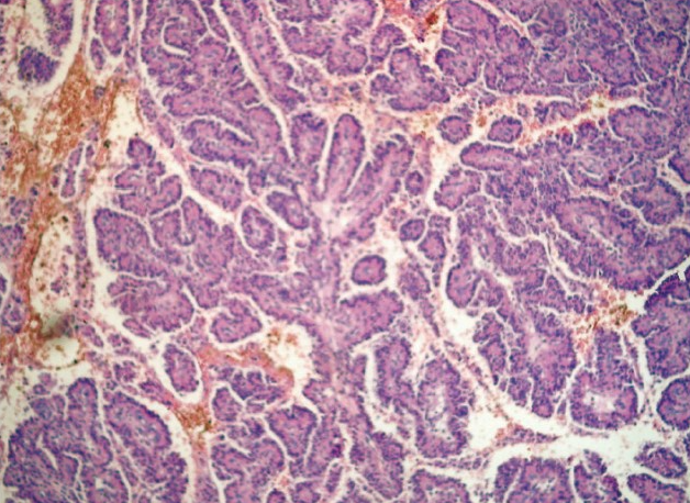 脉络从乳头状瘤的早期症状有哪些？