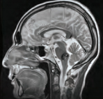 脑干海绵状血管瘤为何手术难度大？