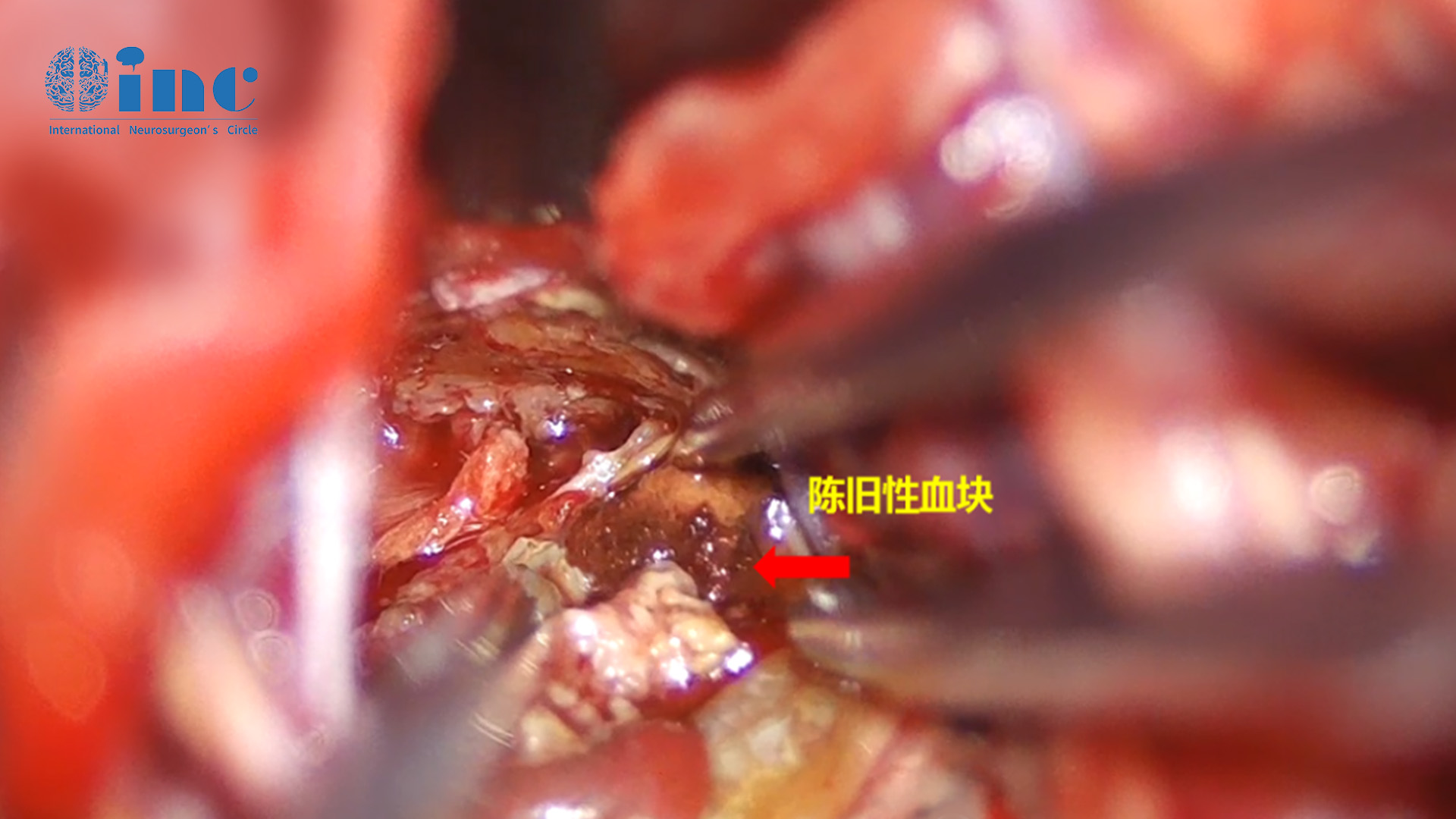 脑干海绵状血管瘤手术图片2