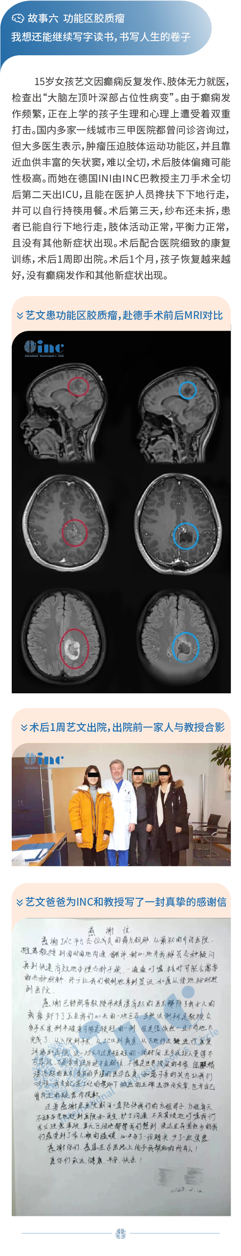 脑胶质瘤案例分享图片
