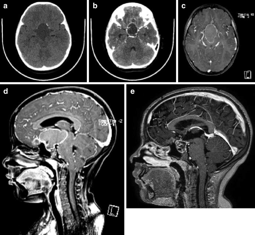 颅咽管瘤较佳治疗时机