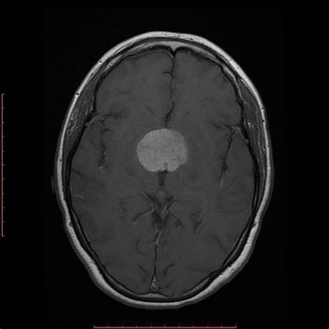 鞍区脑膜瘤的症状和临床表现有哪些？