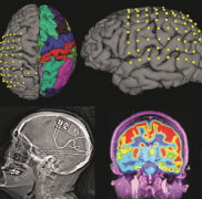 良性癫痫多久发作一次？