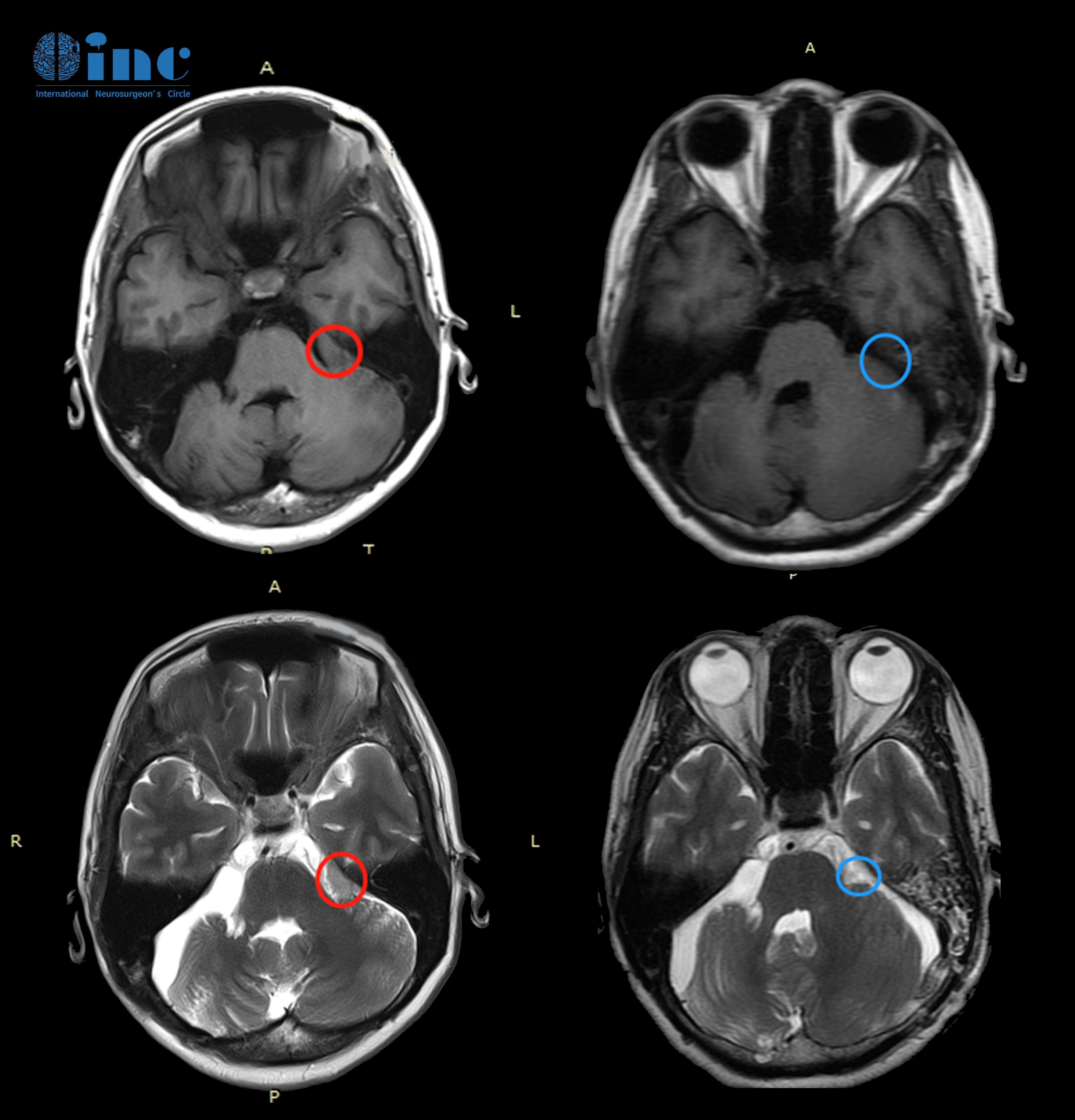 小脑角区脑膜瘤案例图片