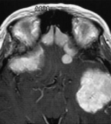 多发性脑膜瘤怎么引起的？