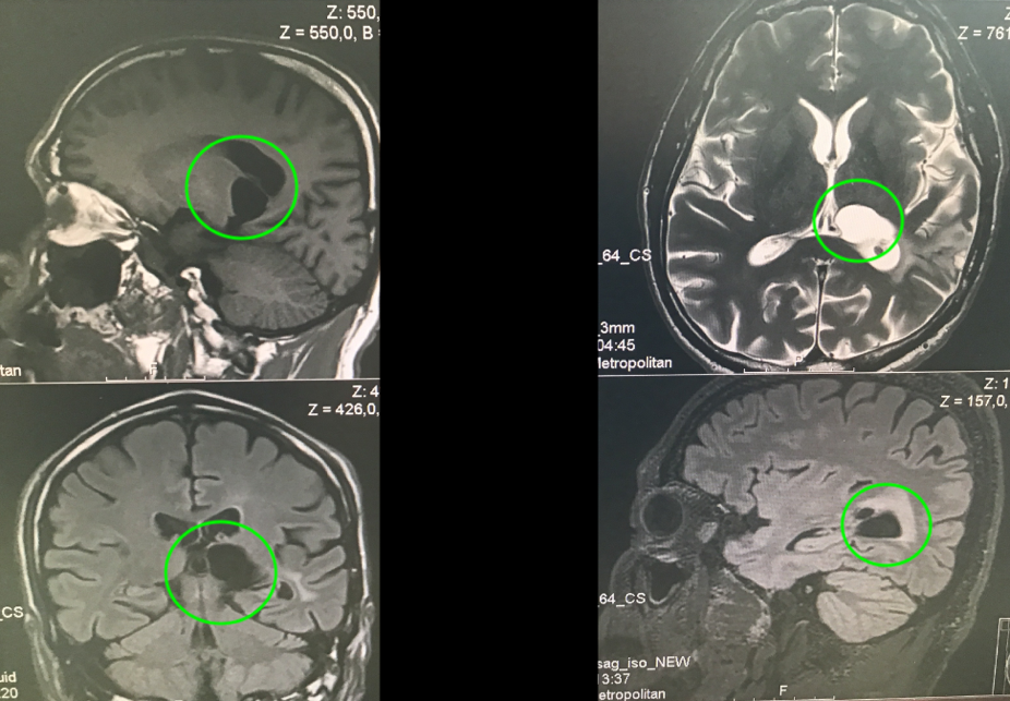 丘<a href='/qianyan/jiaozhiliu/1122.html' target='_blank'><u>脑胶质瘤治疗</u></a>