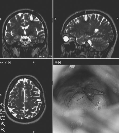 脑海绵状血管瘤和癫痫发作：病灶切除术还是癫痫手术？