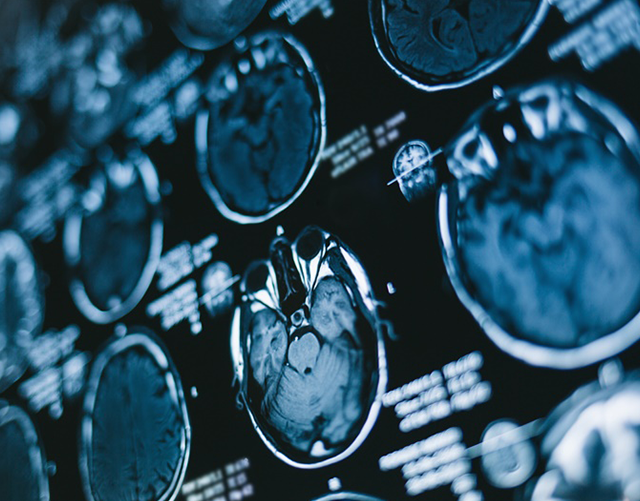 “拇指大”生命中枢脑干常见十大综合征