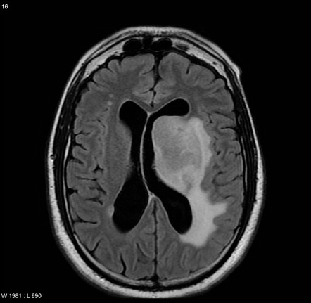 原发性和继发性中枢神经系统淋巴瘤