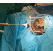 LITT激光间质热疗：药物难治性癫痫的微创手术选择