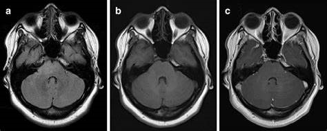 高级别胶质瘤怎么治疗？