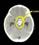 颅咽管瘤全切几率多大？