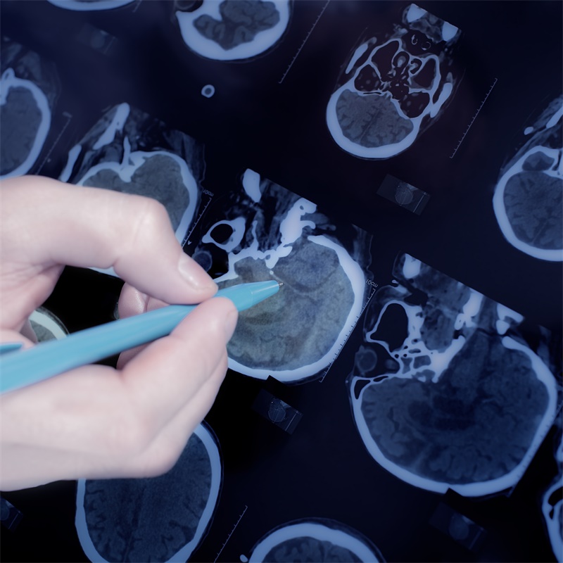 脑海绵状血管瘤的主要临床表现和治疗方法