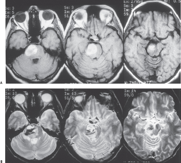 大脑海绵状血管瘤有哪些症状？