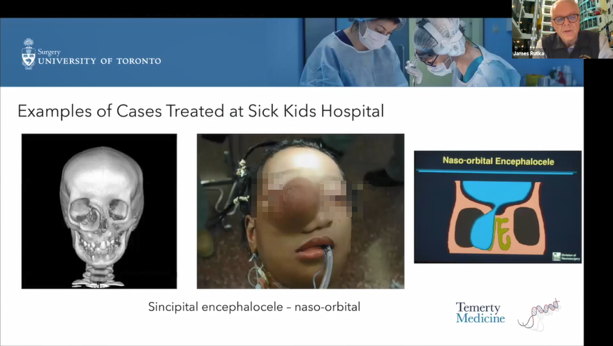 儿童前颅底瘤种、症状、诊断方法及手术