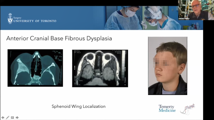 儿童前颅底瘤种、症状、诊断方法及手术