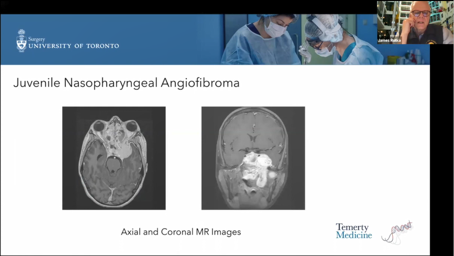 儿童前颅底瘤种、症状、诊断方法及手术