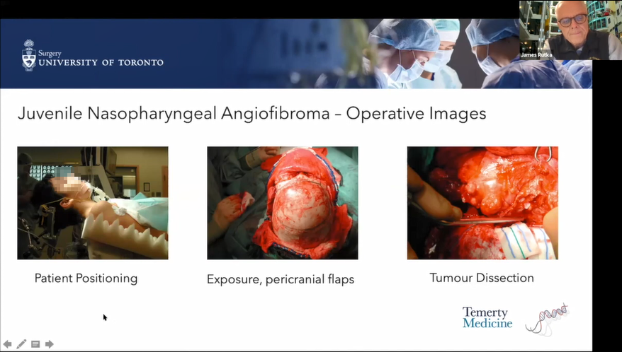儿童前颅底瘤种、症状、诊断方法及手术