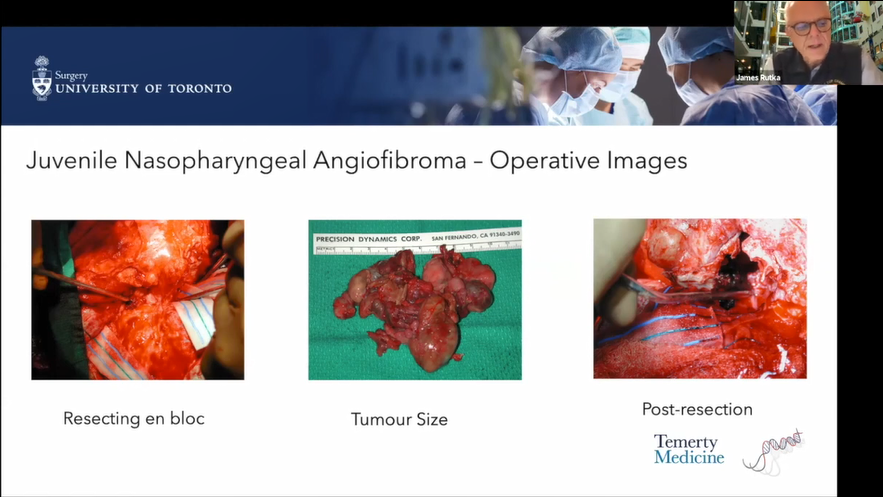 儿童前颅底瘤种、症状、诊断方法及手术