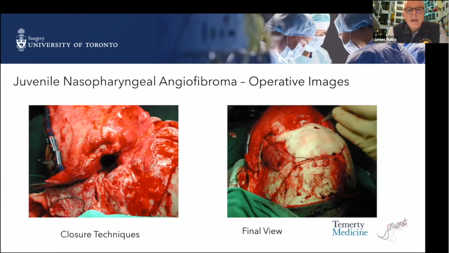 儿童前颅底瘤种、症状、诊断方法及手术