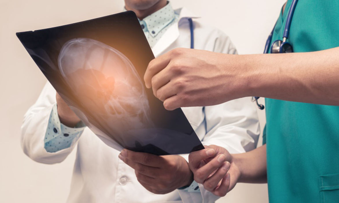 基底节胶质瘤案例图