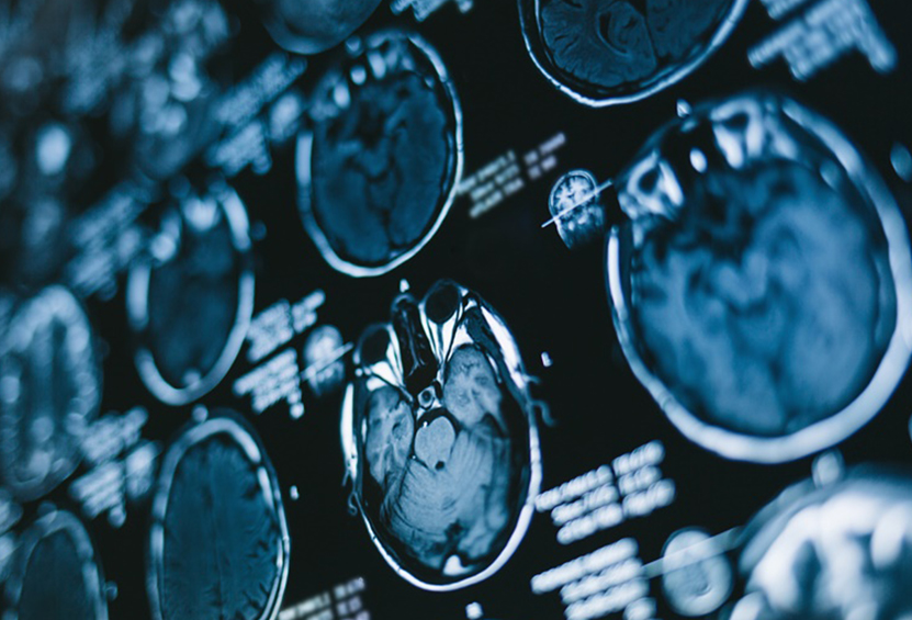 基底节胶质瘤手术