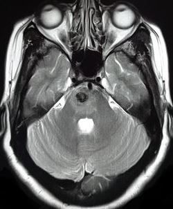颅脑海绵状血管瘤如何发现？