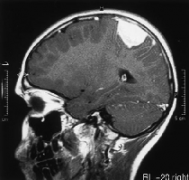 脑膜瘤一般是良性还是恶性？手术治疗原则