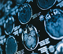 颅咽管瘤二次手术风险大吗？手术注意事项